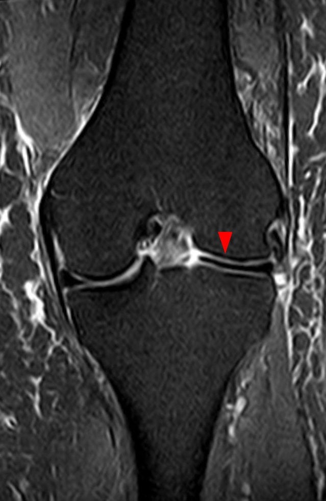 Meniscus Syndrome and Knee Disorders in soccer