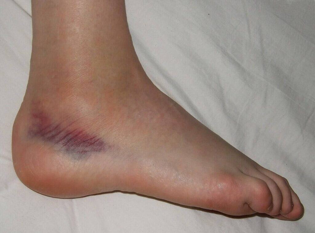 Lateral Ankle Sprains in soccer